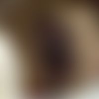 Cobb-Syndrom: Tubero-nodös transformierter Naevus flammeus mit ausgedehntem subkutan-venösen Ante...