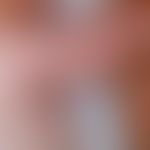 Goltz-Syndrom: Fokale dermale Hypoplasie. 1-jähriges Kind. Abb. entnommen aus:&nbsp;Almashaqbeh S...