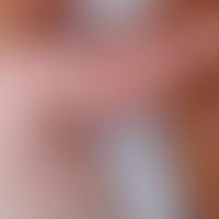 Goltz-Syndrom: Fokale dermale Hypoplasie. 1-jähriges Kind. Abb. entnommen aus:&nbsp;Almashaqbeh S...