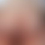 Angiokeratoma circumscriptum: multiple zosteriform angeordnete&nbsp;symptomfrei Knötchen. Abb. en...