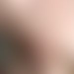 Mamma-Ca, adjuvante Radiatio. Ca. drei Monate später Beginn der Veränderung mit massivem Hautödem...