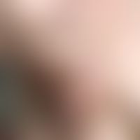 Mamma-Ca, adjuvante Radiatio. Ca. drei Monate später Beginn der Veränderung mit massivem Hautödem...