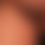 Lilac-Ring: zirkumskripte Sklerodermie mit geröteter Randzone.&nbsp;Deutlich abgesetezt das&nbsp;...