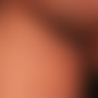 Lilac-Ring: zirkumskripte Sklerodermie mit geröteter Randzone.&nbsp;Deutlich abgesetezt das&nbsp;...