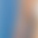 Atrophodermia linearis: bandförmige Atrophodemie bei einr jungen Patienten. Abb. entnommen aus:&n...