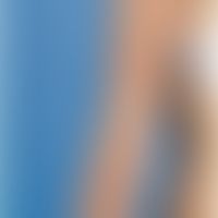 Atrophodermia linearis: bandförmige Atrophodemie bei einr jungen Patienten. Abb. entnommen aus:&n...