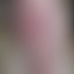 Erythema migrans: 65jährige Patientin. Bei Erstvorstellung Bild eines "Ekzems" am Schienbein. Unt...