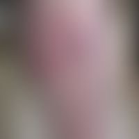 Erythema migrans: 65jährige Patientin. Bei Erstvorstellung Bild eines "Ekzems" am Schienbein. Unt...