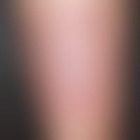 Lyme-Borreliose (Erythema migrans):&nbsp;&nbsp;etwa 2-3 Monate alter Befund mit langsamer periphe...