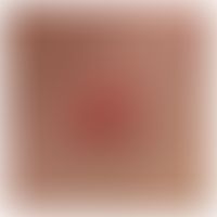 Hyalomma-Zecken: Zeckenbißstelle mit peripherer Entzündung. Abb. entnommen aus: Mathison BA et al...