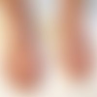 Acrodermatitis chronica atrophicans: Die Erkrankung wurde erst dann diagnostiziert, als die Patie...