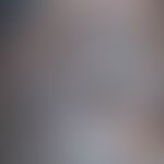 Ochronose exogene: unscharf begrenzte, blau-schwarze, nicht-inflammatorische Hyperpigmentierungen...