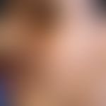 Gesichtspigmentierung, idiopathische, erworbene, gemusterte: unscharf begrenzte, bizarr konfiguri...