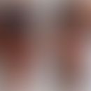 Pigmentierungs-Demarkierungslinien: Die scharfen Übergänge zwischen leicht erythematöser und norm...