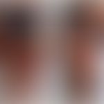 Pigmentierungs-Demarkierungslinien: Die scharfen Übergänge zwischen leicht erythematöser und norm...