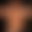 Pseudoleukoderme bei bekannter atopischer Dermatitis. Das hier abgebildete Krankheitsbild entwick...