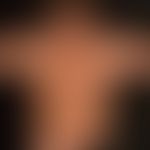 Pseudoleukoderm: 3o jähriger Patient mit bekannter atopischer Dermatitis nach mehrmonatiger Appli...