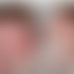 ISQMR: flächige Erytheme mit diffuser Abschuppung der Haut (primär Kollodiumbaby). Abb. entnommen...