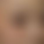 Differenzialdiaganose: Naevus fuscocoeruleus ophthalmomaxillaris

Diagnose:&nbsp;Erworbene&nbsp;b...