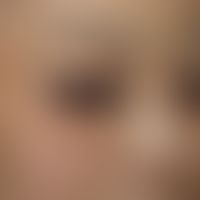 Differenzialdiaganose: Naevus fuscocoeruleus ophthalmomaxillaris

Diagnose:&nbsp;Erworbene&nbsp;b...