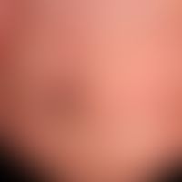 Erythronychie, lokalisierte longitudinale: &nbsp;schmerzlose, rote Längsstreifungen der Nagelplat...