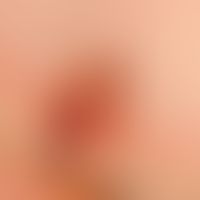 Erythronychie, lokalisierte longitudinale: &nbsp;schmerzlose, rote Längsstreifungen der Nagelplat...