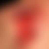 Pyoderma gangaenosum. Chronisches, seit mehr als 1 Jahr&nbsp;&nbsp;progredientes, großflächiges, ...