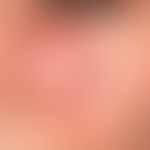 Lupus erythematodes (Kutaner Lupus erythematodes): seit mehreren Jahrzehnten bestehender, schubwe...
