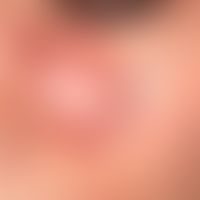 Lupus erythematodes (Kutaner Lupus erythematodes): seit mehreren Jahrzehnten bestehender, schubwe...