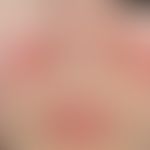 Lupus erythematodes (Kutaner Lupus erythematodes): seit mehreren Jahren&nbsp;bestehender,&nbsp; v...