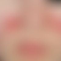Lupus erythematodes (Kutaner Lupus erythematodes): seit mehreren Jahren&nbsp;bestehender,&nbsp; v...