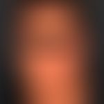 Parry-Romberg-Syndrom:&nbsp; idiopathische linksseitige Hemiatrophie
