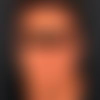 Parry-Romberg-Syndrom:&nbsp; idiopathische linksseitige Hemiatrophie
