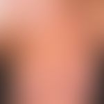 Makulopapulöse kutane Mastozytose: Adulte Form der Urticaria pigmentosa (Erythrodermie). Bei jahr...