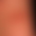 Mastozytom kutanes:&nbsp;nach Reiben, zentrale Basenbildung (durch Pfeile markiert).&nbsp;Durch V...