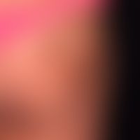 Lipoatrophie, lokalisierte nach Glukokortikosteroid-Injektionen. Eingesunkenes Areal mit weißlich...