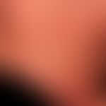 Differenzialdiagnose: Skleromyxödem

Diagnose: Diffuse kutane Mastozytose

Seit Geburt bestehende...