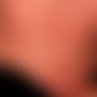 Differenzialdiagnose: Skleromyxödem

Diagnose: Diffuse kutane Mastozytose

Seit Geburt bestehende...