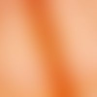 Melanin: streifige Melnaninvermehrung in der Nagelmatrix
