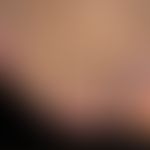 Papillomatosis cutis lymphostatica:&nbsp;exzessiver Befund mit flächigen baumrindenartigen Borken...