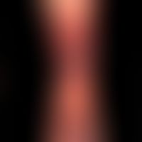Vaskulitis, leukozytoklastische (non-IgA-assoziierte):&nbsp;große, hämorrhagische Blasen auf fläc...