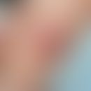 Dermatitis exsudative diskoide lichenoide: nummuläre&nbsp;stark juckende Plaque. Abb.entnommen au...