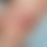 Dermatitis exsudative diskoide lichenoide: nummuläre&nbsp;stark juckende Plaque. Abb.entnommen au...