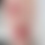 Dermatitis exsudative diskoide lichenoide: nummuläre&nbsp;stark juckende Plaques. Abb.entnommen a...