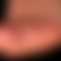 Acrodermatitis continua suppurativa:&nbsp; seit Jahren chronisch rezidivierendes Krankheitsbild m...