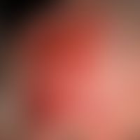 Pemphigoid vernarbendes Typ Brunsting-Perry (Folgeaufnahme 2,5 Jahre unter immunsuppressiver Ther...