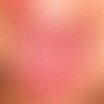Lingua plicata kombiniert mit Exfoliatio areata linguae als Teilsymptome eines Melkersson-Rosenth...