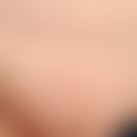 Keratosis-pilaris-Syndrom:&nbsp;Schleichender Verlust der Pubes-Behaarung. Weitgehender&nbsp; Ver...