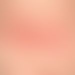 Differenzialdiagnose: Naevus flammeus asymmetrischer

Diagnose: Unna-Pollitzer-Nackennaevus (Ange...