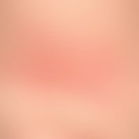 Differenzialdiagnose: Naevus flammeus asymmetrischer

Diagnose: Unna-Pollitzer-Nackennaevus (Ange...